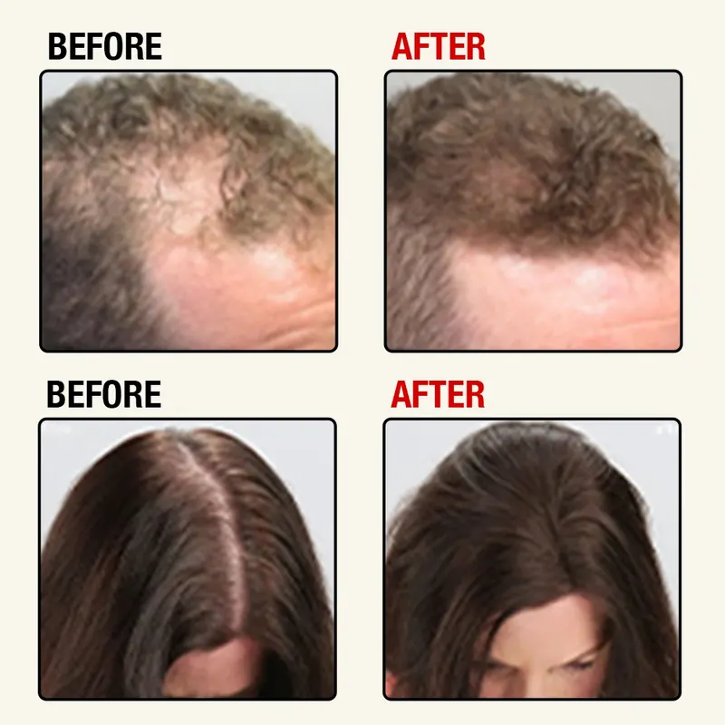 Glokore hair regrowth cap before and after results for men and women