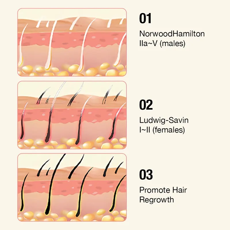 Hair loss stages Glokore targets including Norwood Hamilton and Ludwig Savin patterns